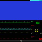 Heart Monitor for a hospital bed